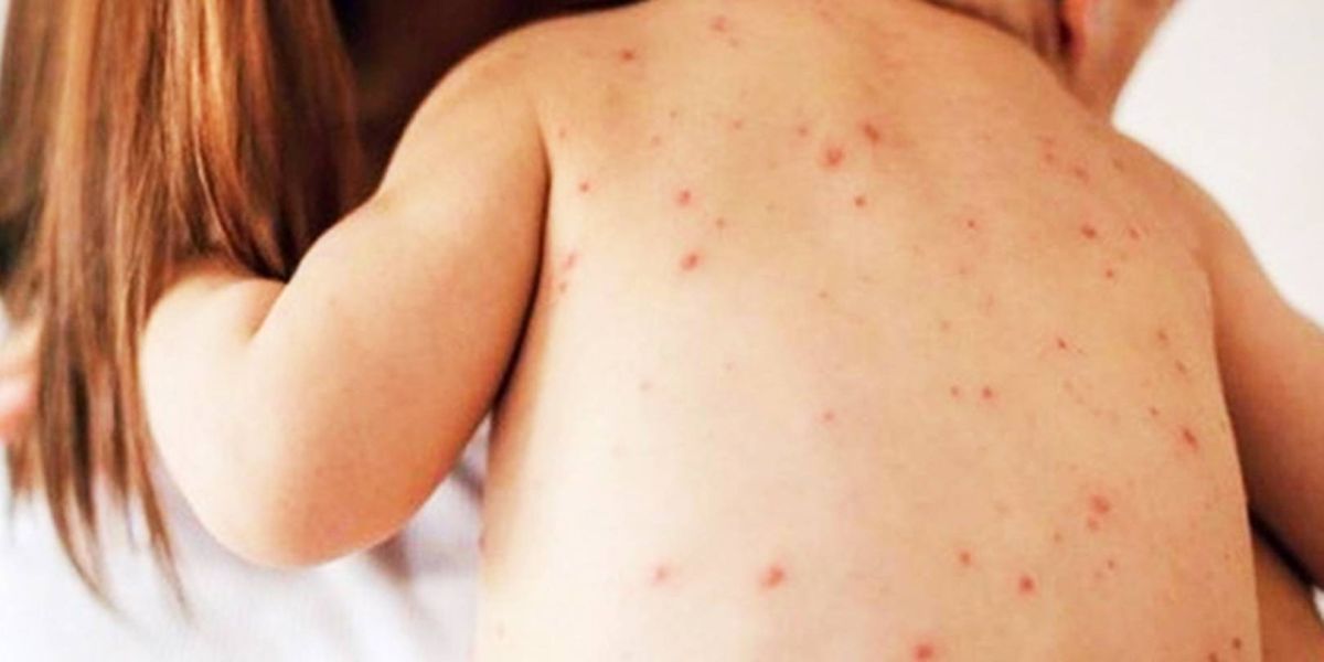 Paraná tem mais 10 casos de sarampo, 70% são jovens de 20 a 29 anos