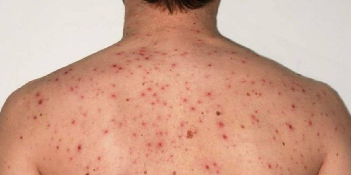 Saúde do Paraná alerta que transmissão de sarampo ainda continua