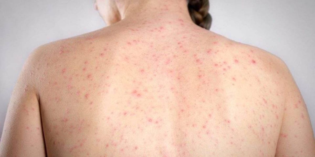 Paraná tem 1.051 casos confirmados de sarampo