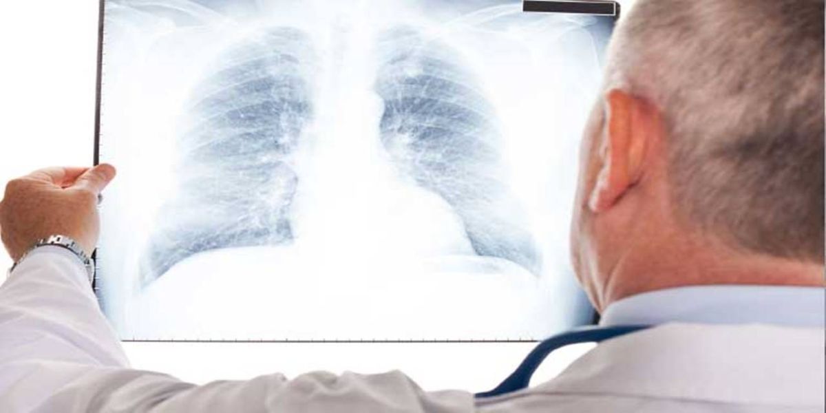 Boletim mostra tendência de aumento em casos de internação por Síndrome Respiratória Aguda Grave