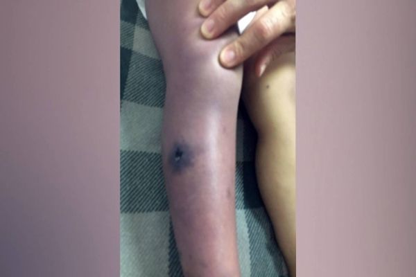 Menina de dois anos morre em Toledo e suspeita é picada de aranha