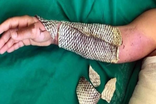 Médicos brasileiros levarão pele de tilápia para tratar queimaduras de feridos no Líbano