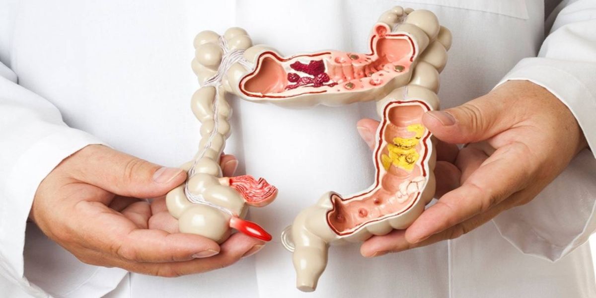 Câncer de intestino: tudo que você precisa saber