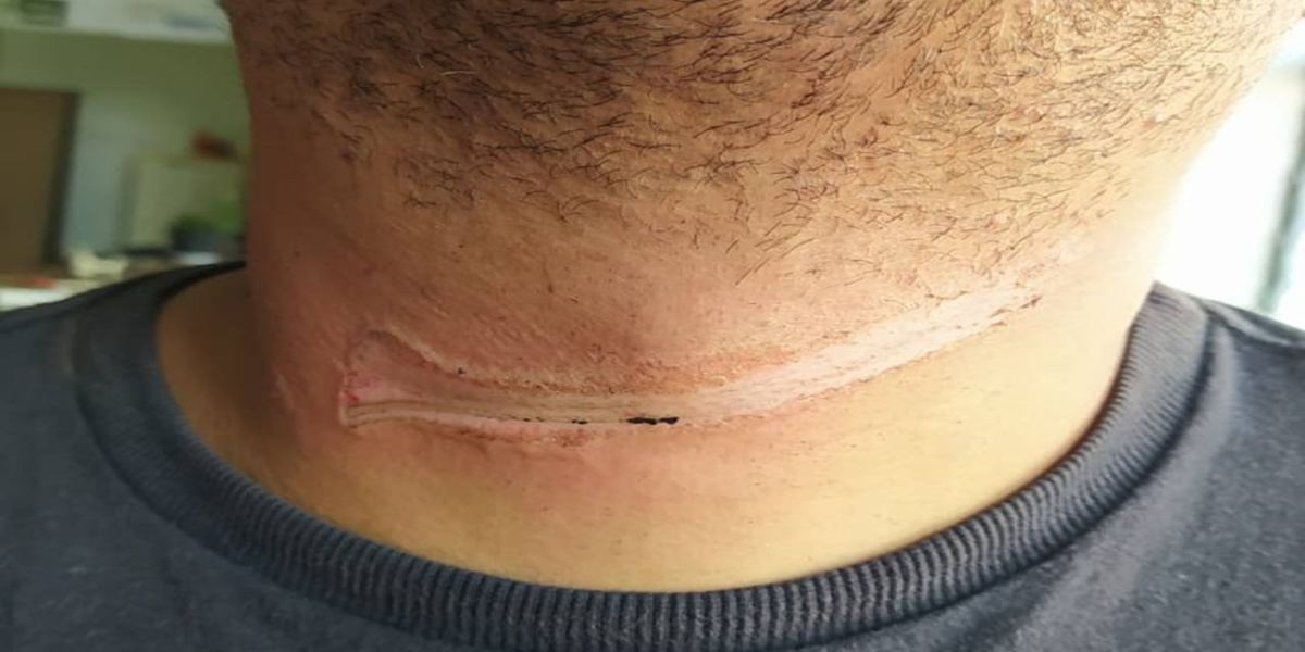 Motociclista tem pescoço ferido por cabos de telefonia solto no Bairro São Cristóvão