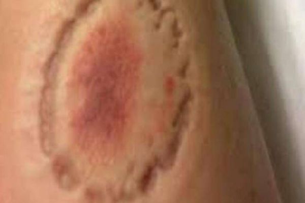 Mulher é agredida e mordida pelo marido após discussão por banho de criança