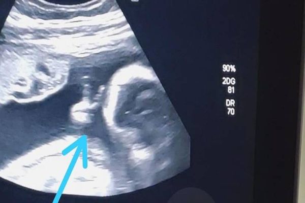 Bebê faz ‘V de vitória’ durante ultrassom e pai com câncer raro vê sinal divino: ‘Mais força’