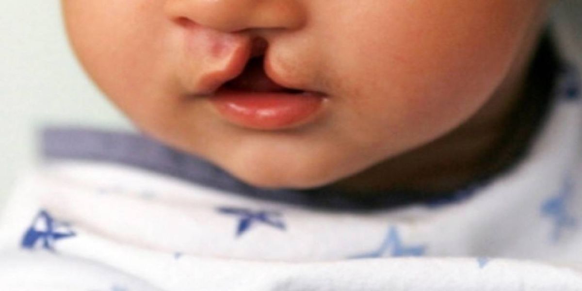 Hospitais serão obrigados a informar entidades de referência sobre neonatos com fissura labiopalatal