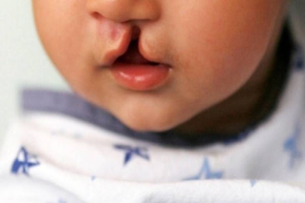 Hospitais serão obrigados a informar entidades de referência sobre neonatos com fissura labiopalatal