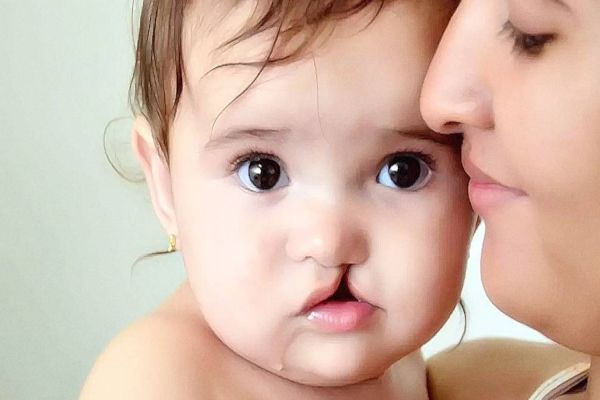 Agora é Lei: Hospitais e maternidades são obrigados a comunicar casos de deformidade labiopalatal