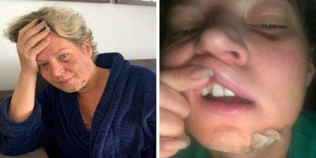 Joice Hasselmann tem fraturas pelo corpo e acredita ter sido vítima de um 'atentado'