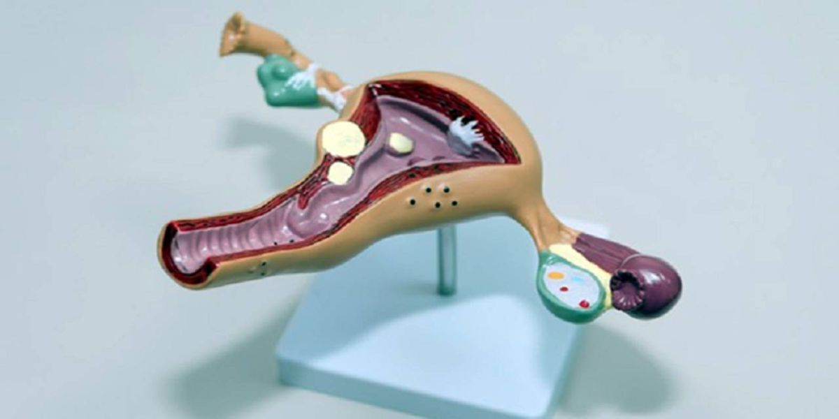 Saúde da mulher: Saiba se você tem a síndrome do ovário policístico