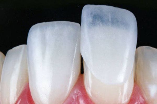 Lentes de contato dentais contribuem para aumento da autoestima