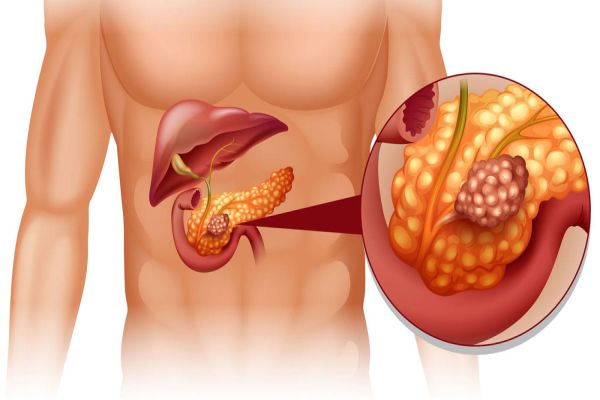 Câncer de pâncreas: diagnósticos precoces diminuem a mortalidade de pacientes, destaca médico