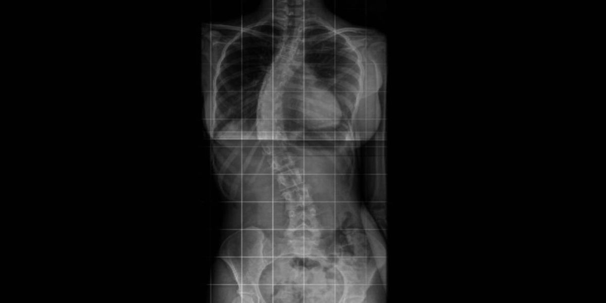 Jovem de Cascavel precisa de ajuda para realizar cirurgia para correção da escoliose idiopática