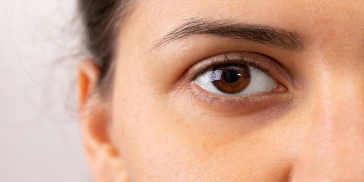 Olheiras, entenda porque elas aparecem e como tratar