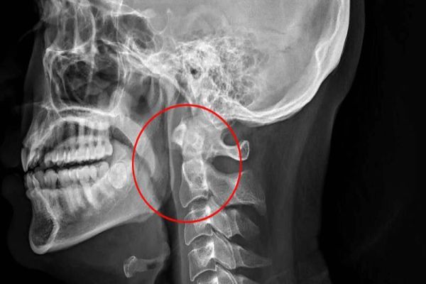 Homem é hospitalizado após tapar a boca e o nariz enquanto espirrava