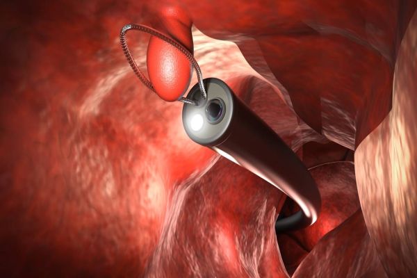 Ao menos 148 mil colonoscopias deixaram de ser realizadas no SUS em dois anos de pandemia