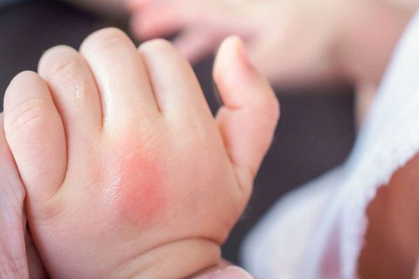 O fim da picada! Como lidar com os insetos no verão