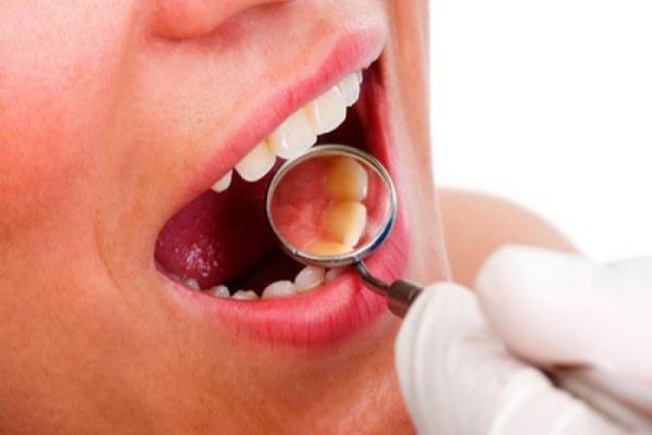 Prevenção e diagnóstico precoce são essenciais no combate ao câncer bucal