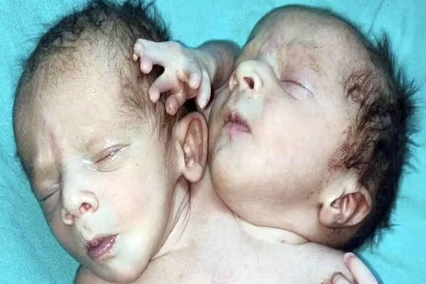Gêmeos siameses nascem com três braços e duas cabeças, na Índia