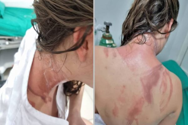 Famoso 'trote' deixa universitários com queimaduras com Creolina