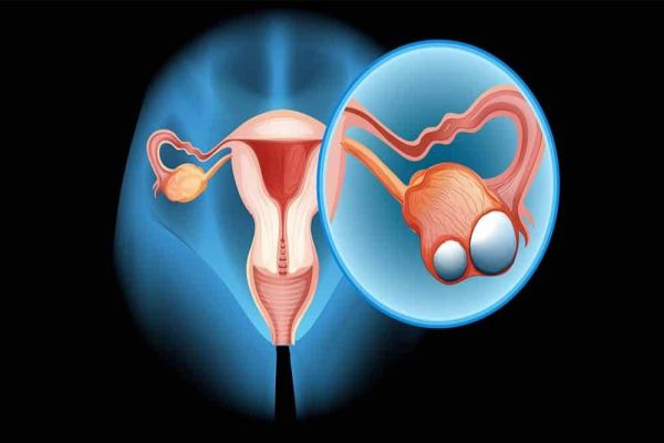 Mulheres com infertilidade são mais vulneráveis ao câncer de ovário