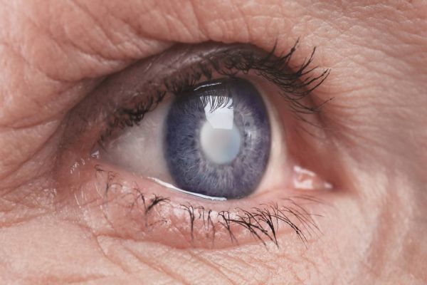 Medo de cirurgia afasta pacientes de catarata do tratamento