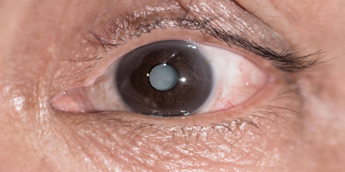 Catarata é a principal causa de cegueira do mundo