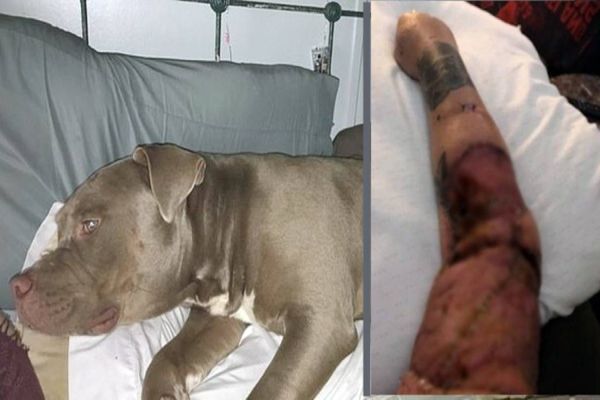 Pit bull tem ataque de raiva e arranca pedaço de braço da dona