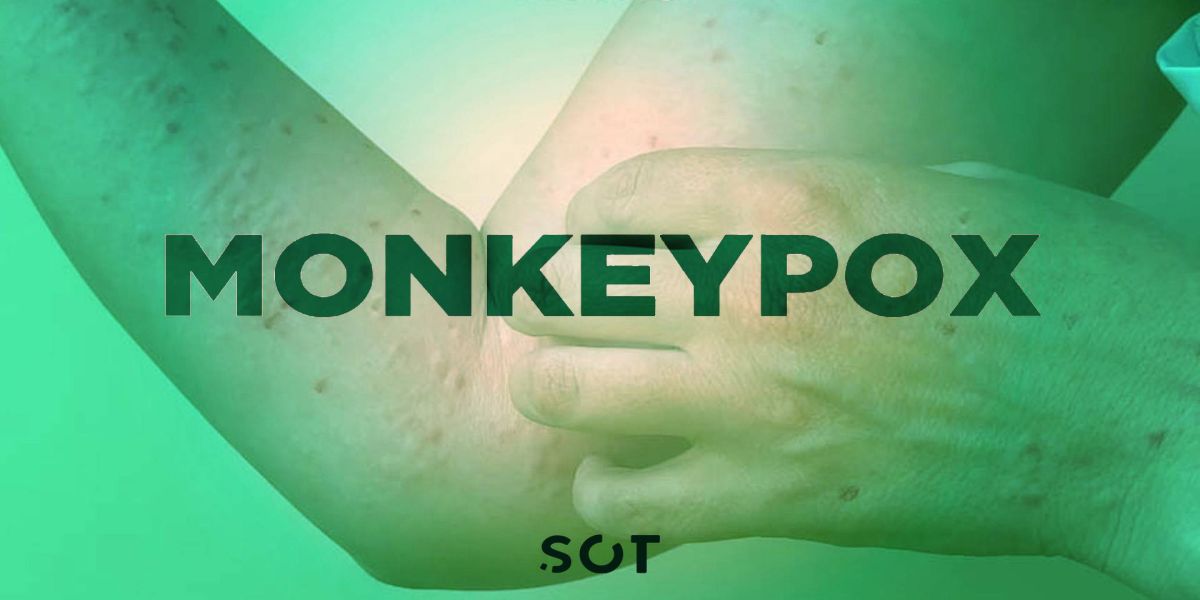 Cascavel confirma oficialmente o primeiro caso de “monkeypox” varíola dos macacos