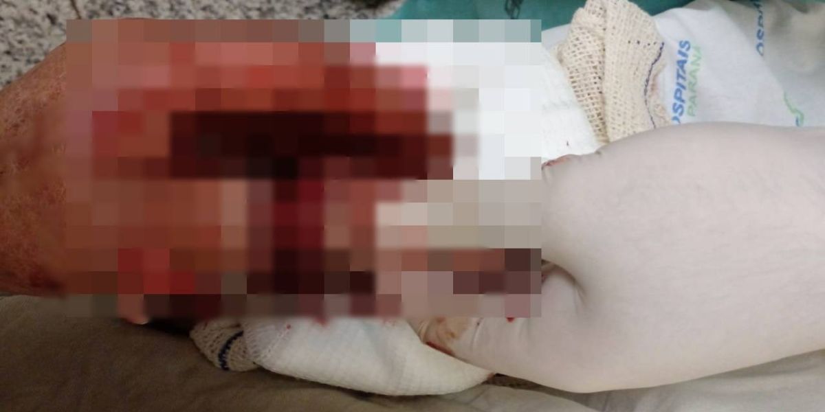 Idoso tem dedo da mão decepado após ataque de cachorro no Bairro Lago Azul