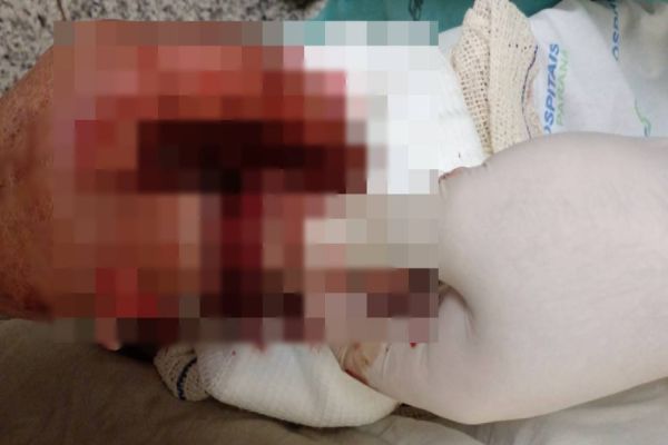 Idoso tem dedo da mão decepado após ataque de cachorro no Bairro Lago Azul