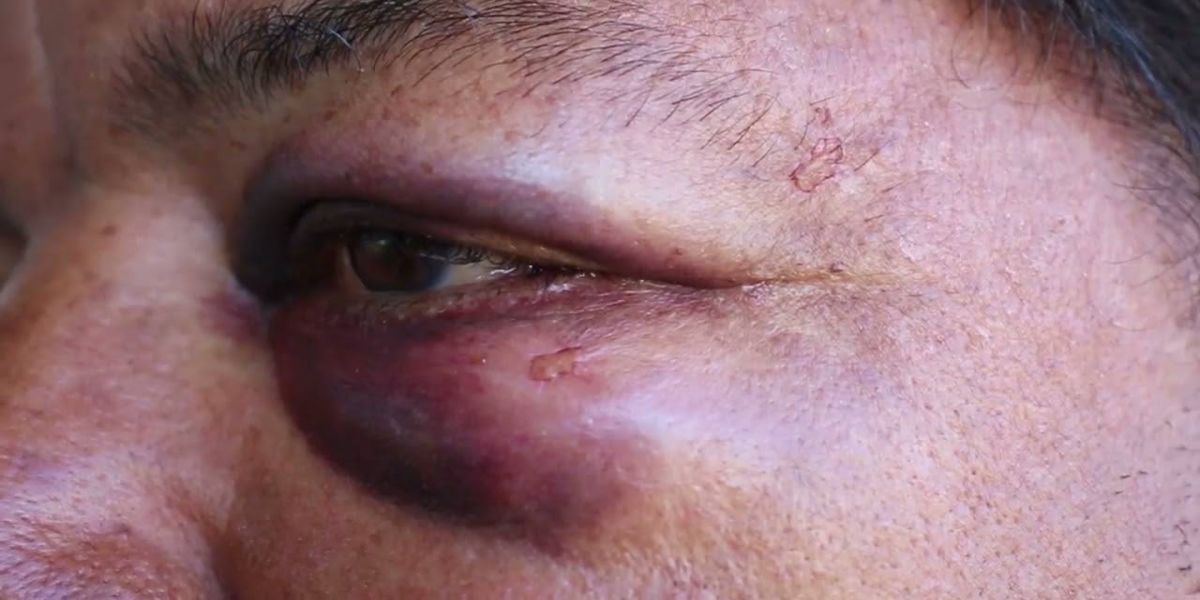 Homem é agredido a marteladas por companheira, após ela desconfiar que ele saia com outra