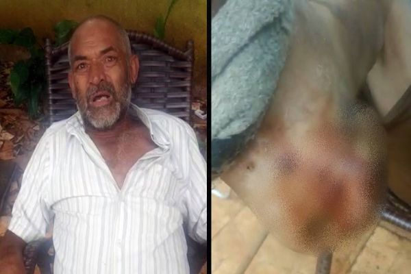 Morador do 14 de Novembro clama por ajuda para conseguir uma cirurgia no pé