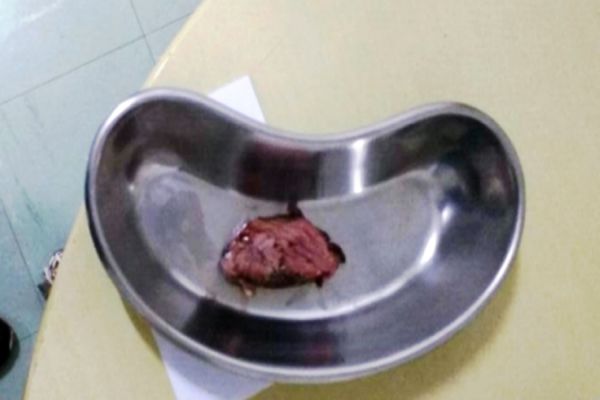 Mulher morre engasgada com pedaço de carne no interior do Paraná