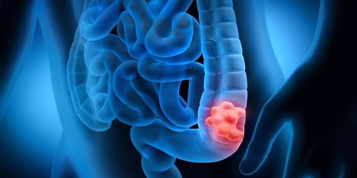 Prefeitura de Toledo e clínica especializada estimulam a prevenção ao câncer colorretal