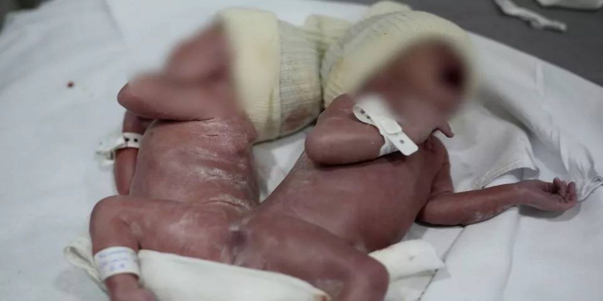 Caso raro: Gêmeos nascem unidos por osso da coluna no Paraná