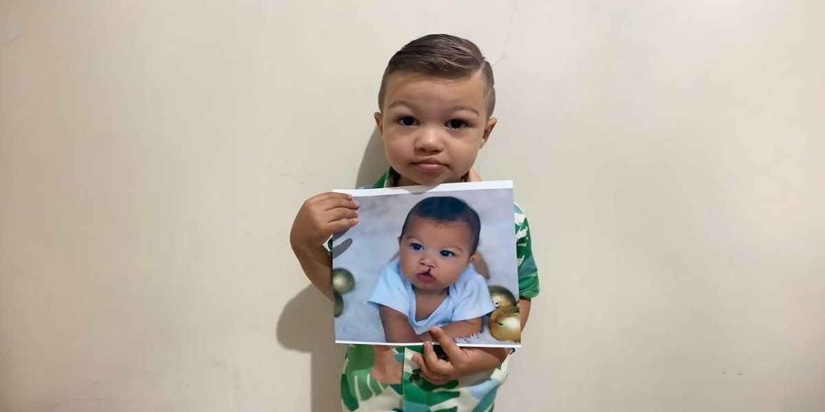 Fissura Labiopalatal tem tratamento e hoje é o dia de lembrar do tema