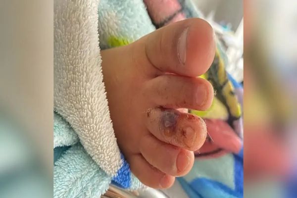 Criança de 3 anos é picada por cobra jararaca em creche na Serra, diz mãe