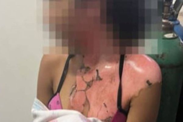 Mulher joga água fervente na sobrinha de 14 anos por ciúmes do marido