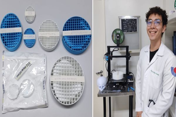 Tecnologia: HUOP realiza primeira cirurgia craniana com molde criado em impressora 3D