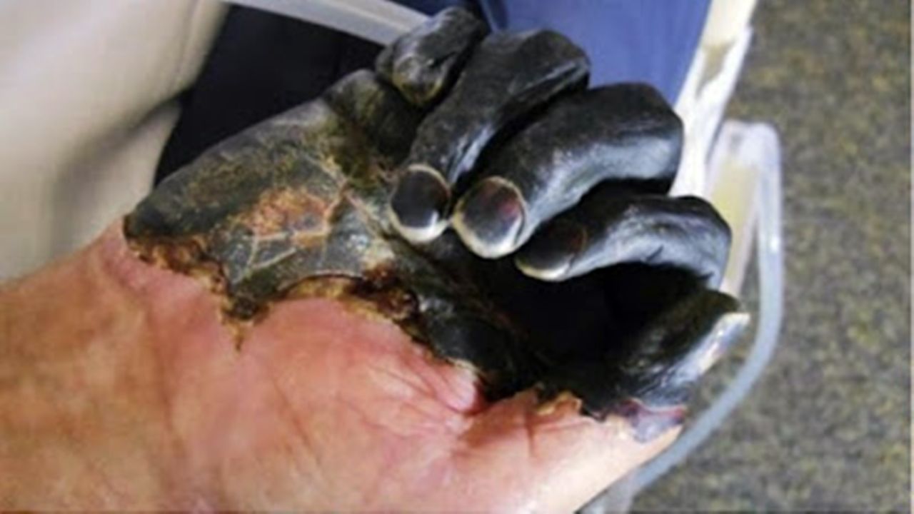 Caso de Peste Negra é confirmado na Califórnia, nos Estados Unidos