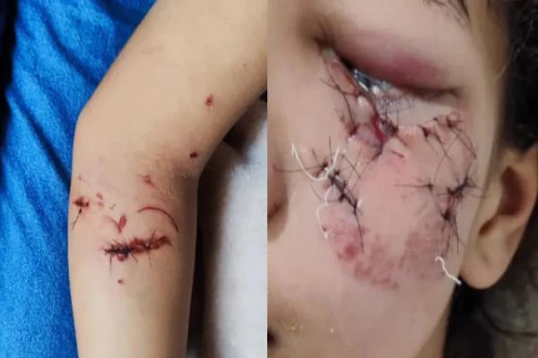 Imagem referente a notícia: Criança de 11 anos é brutalmente atacada por cachorro no Paraná