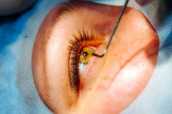 Mais de 2 mil pessoas aguardam por transplante de córnea no Paraná