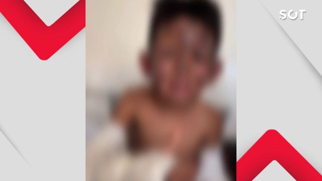 Explosão em churrasqueira deixa menino de 7 anos gravemente ferido e família pede ajuda para custear tratamento