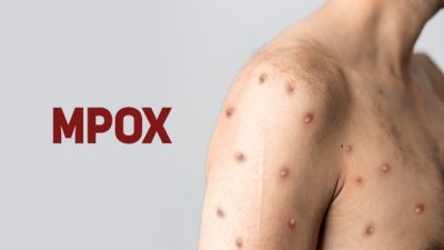 Imagem referente a notícia: Sobe para 140 número de casos confirmados de Mpox no país, em 2026