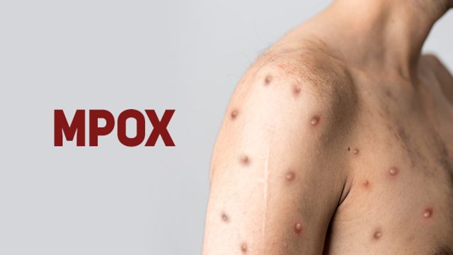 Imagem referente a notícia: Sobe para 140 número de casos confirmados de Mpox no país, em 2026