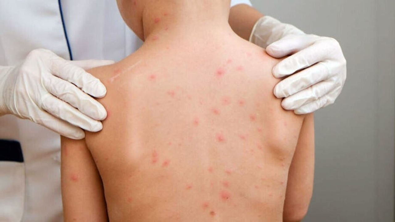 Caso de meningite viral é confirmado e dois suspeitos estão sob investigação em Corbélia