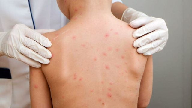 Imagem referente a notícia: Caso de meningite viral é confirmado e dois suspeitos estão sob investigação em Corbélia