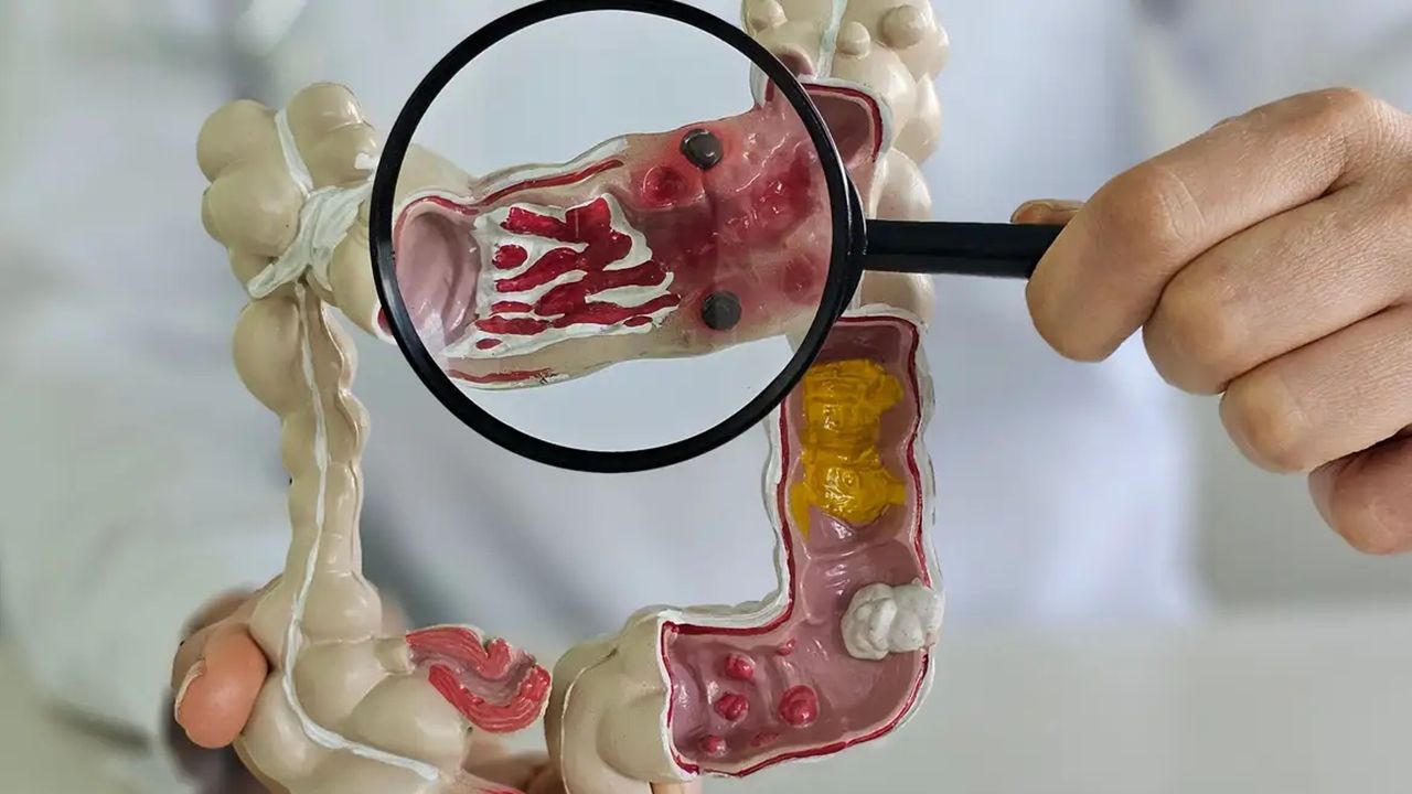 Em 13 anos, doença inflamatória intestinal cresce 5 vezes no Brasil